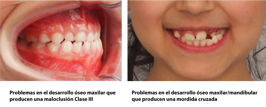 tratamiento temprano ortodoncia